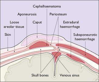 Hemorrhage subaponeurotic Subgaleal hematoma