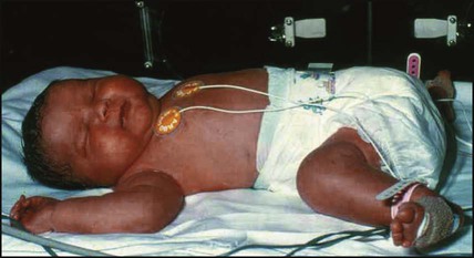 Plethora In Newborn