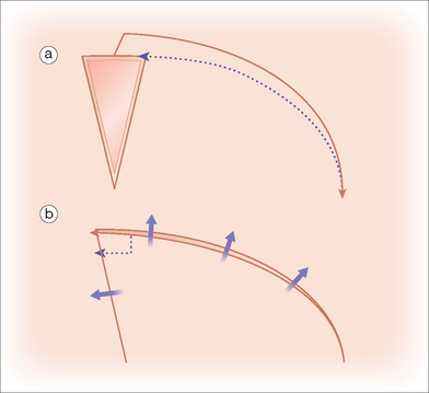 Rotation Flaps Clinical Gate