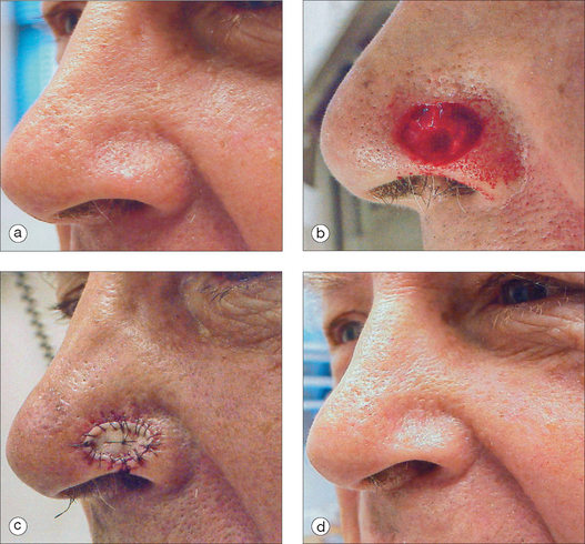 Nasal Reconstruction Clinical Gate