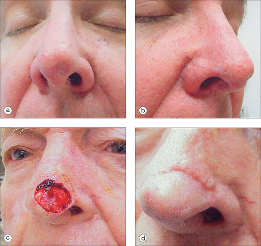 Nasal Reconstruction Clinical Gate