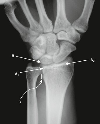 Radiographic Evaluation and Classification of Distal Radius Fractures ...