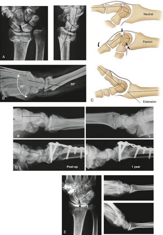Osteotomy For Extra Articular Malunion Of The Distal Radius Clinical Gate