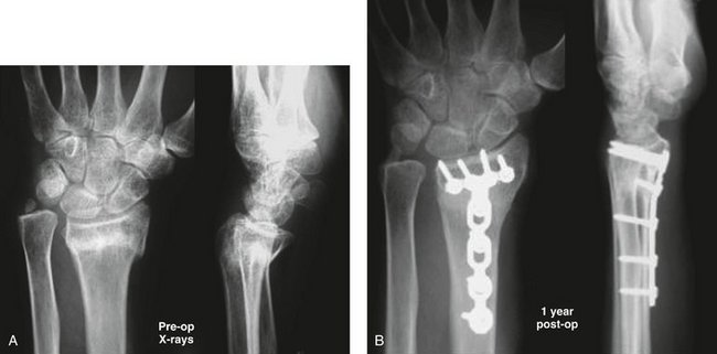 Osteotomy For Extra-articular Malunion Of The Distal Radius | Clinical Gate