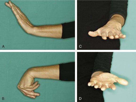 Arthroscopic-Assisted Osteotomy For Intra-articular Malunion Of The Distal Radius | Clinical Gate