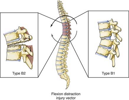 Diagnosis And Management Of Thoracic Spine Fractures Clinical Gate