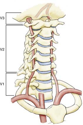 Сегмент v4 правой позвоночной артерии. Сегмент v1 v2 позвоночной артерии. V3 сегмент позвоночной артерии. Сегмент v1 позвоночной артерии. 2 Сегмент позвоночной артерии.