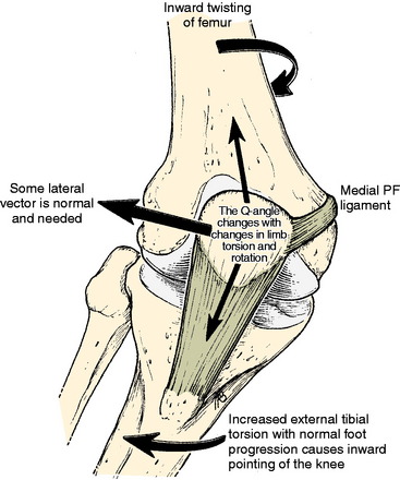 Patellofemoral Disorders: Correction of Rotational Malalignment of the ...