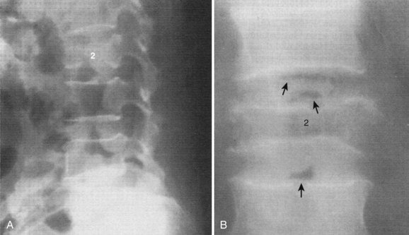 Infections of the Spine | Clinical Gate
