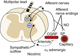 Spinal Cord Stimulation For Chronic Pain | Clinical Gate