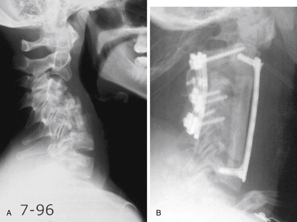 Management Of Cervical Spondylotic Myelopathy | Clinical Gate