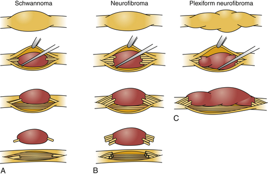 peripheral-nerve-tumors-of-the-extremities-clinical-gate