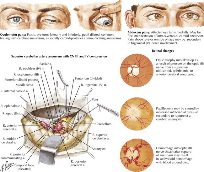 Cranial Nerve 3 Palsy