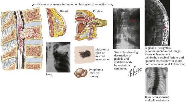 Spinal Cord Tumors | Clinical Gate