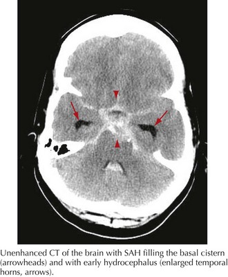 CT brain image gallery - SAH
