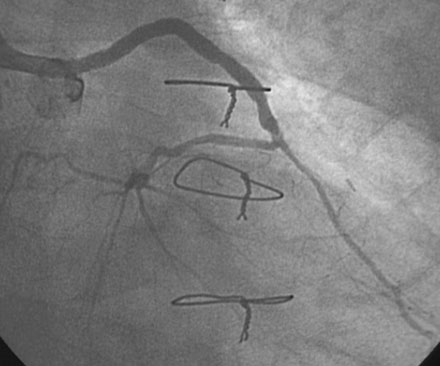 7: Saphenous Vein Graft Disease | Clinical Gate