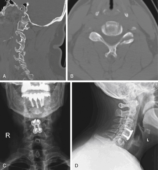 Subaxial Cervical Spine Injuries | Clinical Gate