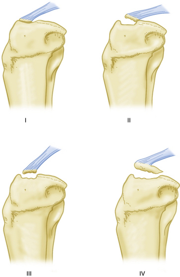 Arthroscopic Management Of Tibial Plateau Fractures Clinical Gate 3750