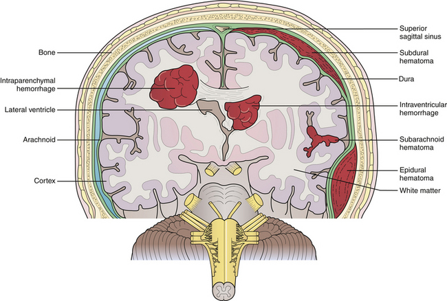 Intraparenchymal Hemorrhage Vs Intraparenchymal Hematoma Table Hot Sex Picture 1510