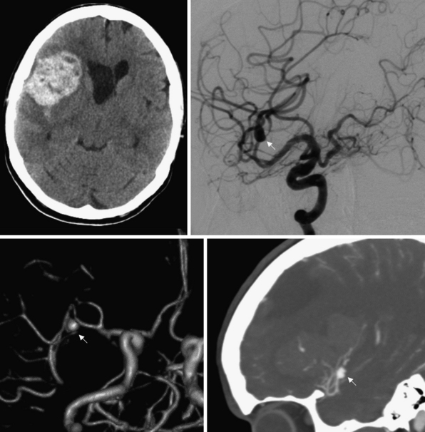 Spontaneous Intracerebral Hemorrhage | Clinical Gate