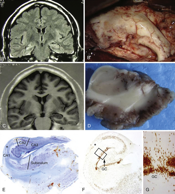 medial temporal lobe epilepsy