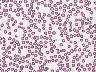 Thrombocytopenia Clinical GateClinical Gate
