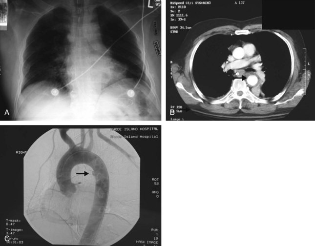 Thoracic Trauma | Clinical Gate