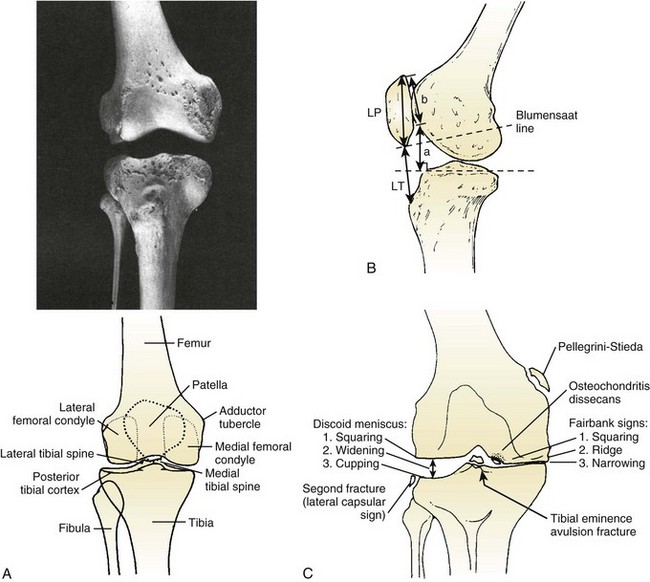 Tibial Epicondyle