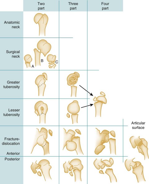 Injuries to the Shoulder Girdle and Humerus | Clinical Gate