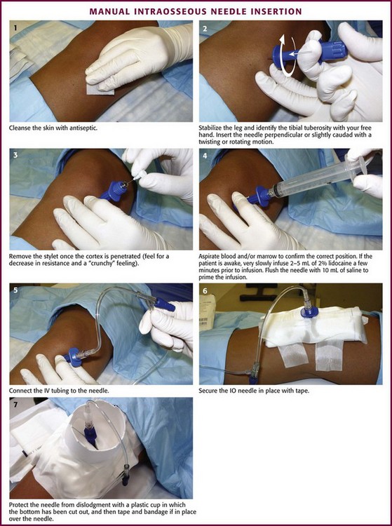 Intraosseous Infusion Sites