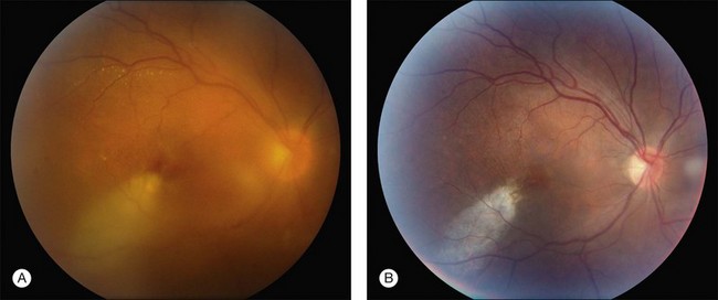 Endogenous Endophthalmitis: Bacterial And Fungal | Clinical Gate