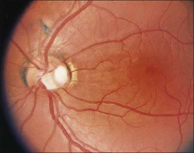 Optic Disc Anomalies Pits And Associated Serous Macular Detachment Optic Disc Anomalies Pits And Associated Serous Macular Detachment