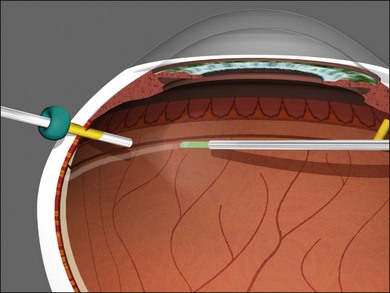 Principles And Techniques Of Vitreoretinal Surgery | Clinical Gate