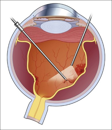 Management Of Combined Inflammatory And Rhegmatogenous Retinal ...