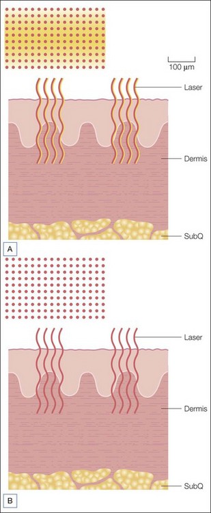 Laser Resurfacing | Clinical Gate