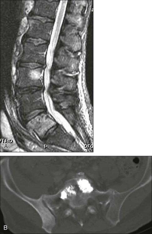 Spinal Cord Compression | Clinical Gate