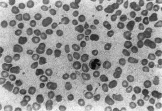 Inherited Forms Of Bone Marrow Failure Clinical Gate