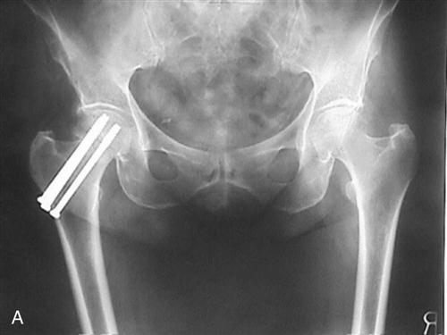 Open Reduction Internal Fixation of the Pelvis