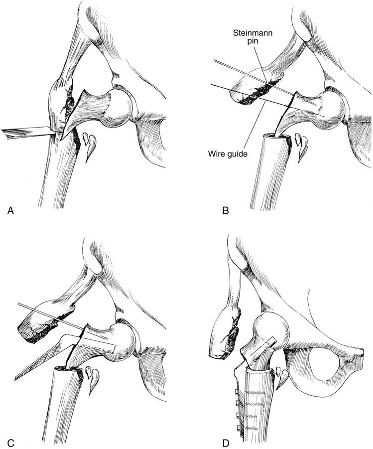 Open Reduction Internal Fixation of the Pelvis