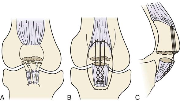 Open Fracture of the Patella - JETem