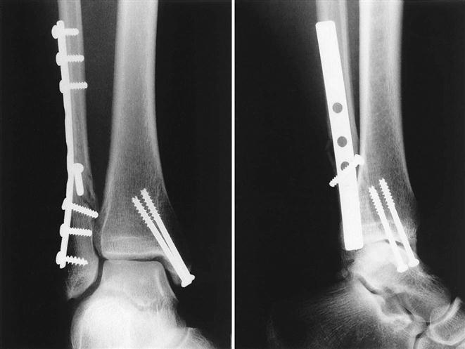 Ankle fracture: Lateral malleolar fixation using Acumed Fibula Rod System  Surgical Technique - OrthOracle