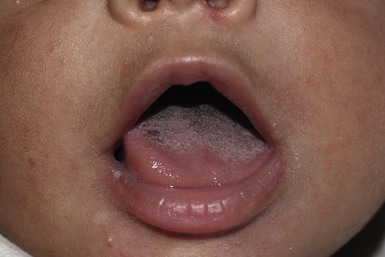 Wart on baby s tongue, Ce fac viermii