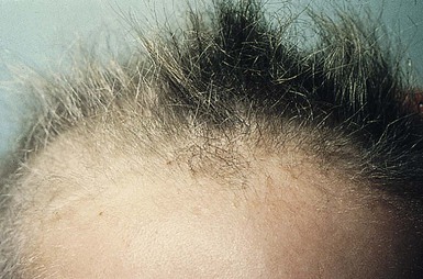 Hair Disorders | Clinical Gate