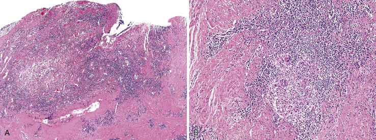 Anal Canal Inflammation 75