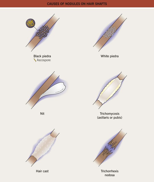 Fungal Diseases Clinical Gate
