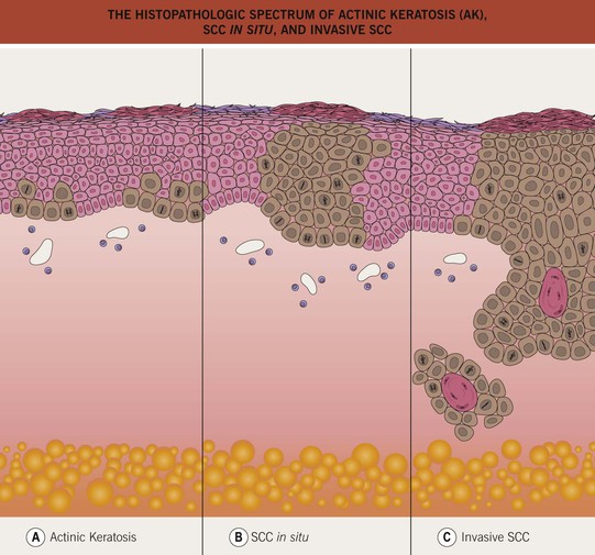 Actinic Keratosis Appearance Vs Squamous Cell Carcino