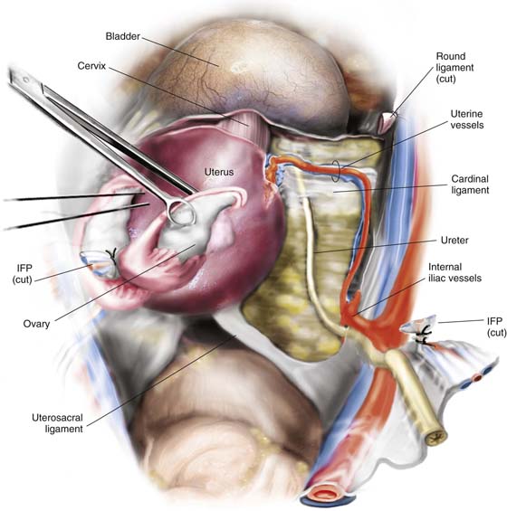 uterosacral ligament ureter