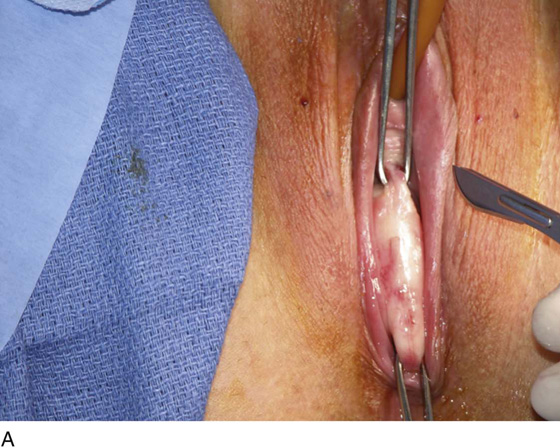Effects Of Vaginal Prolapse Surgery On Sexuality In Women And Men Results