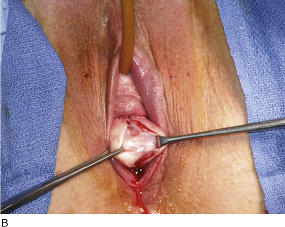 Vaginal Surgery Information