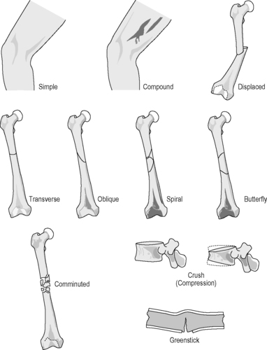 Bone and joint injuries | Clinical Gate